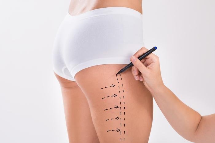 Liposuction