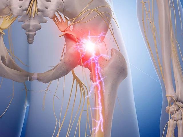 Peripheral neuropathy is a complex condition that affects millions of individuals worldwide, causing a range of symptoms from tingling and numbness to sharp, shooting pain. In this comprehensive guide to nerve pain,