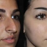 Refine Your Nose: Dubai's Premier Rhinoplasty