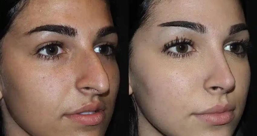 Refine Your Nose: Dubai's Premier Rhinoplasty