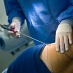 Liposuction in Abu Dhabi