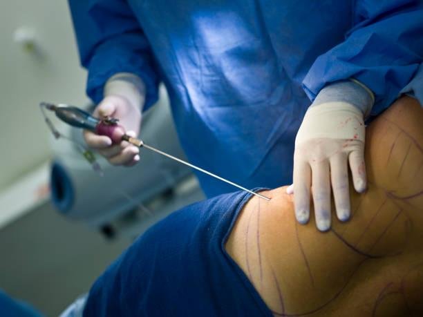 Liposuction in Abu Dhabi