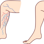 Varicose Veins