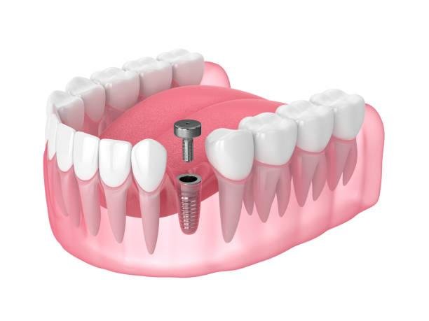 Dental Implant Osseointegration